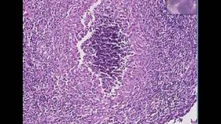 Histopathology Lymph nodeTularemia [upl. by Colas]