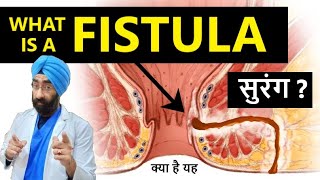 क्या होता है भगन्दर फिस्टुला  What is a FISTULA  DrEducation Hindi Eng [upl. by Innad]