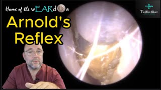 Arnolds Reflex 174 ear earwax earwaxremoval earcleaning asmr asmrearwax satisfying [upl. by Rihana]