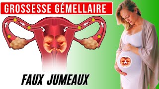 Grossesse gémellaire mécanisme de formation des faux jumeaux [upl. by Miahc253]