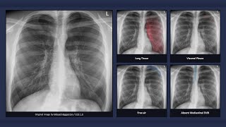 Tension Pneumothorax Explanation of Chest Xray Findings [upl. by Asiole]