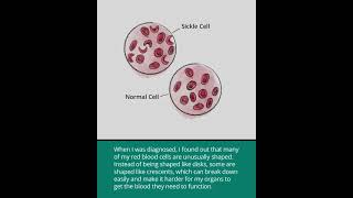 Sickle Cell Disease Hemoglobin S Disease [upl. by Verena692]