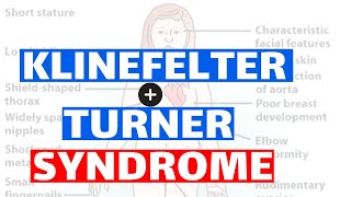 Klinefelter amp Turner syndrome  Pathology Clinical features Diagnosis and Treatment [upl. by Schach517]