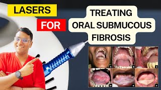 Dr Rudra Mohan  Oral Submucous FIbrosis Treatment with Laser Therapy  OSMF Treatment Diode Laser [upl. by Aronaele]