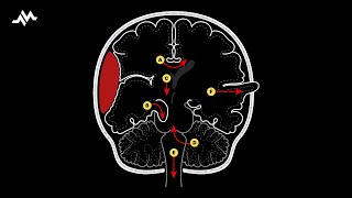 Brain Herniation Syndromes [upl. by Brenden76]