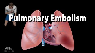 pulmonary Embolism symptoms pulmonary artery pulmonary trunk Embolism symptoms signs treatment [upl. by Honora]