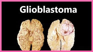 Glioblastoma Multiforme – Symptoms Diagnosis and Treatment ✔ [upl. by Hamlin23]