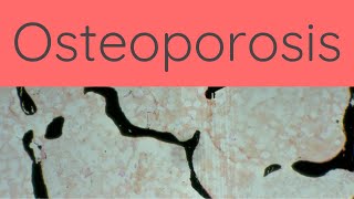 What is Osteoporosis  Pathology mini tutorials [upl. by Antoine782]