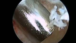 Posterior Arthroscopy with Haglunds Deformity Debridement SFISM [upl. by Gewirtz]