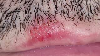 clearing lips herpes cold sores dead skin and ingrown hairs [upl. by Kabob]