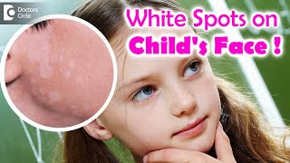 5 Things to know if your child is suffering from Pityriasis Alba  Dr Divya SharmaDoctors Circle [upl. by Farmer688]