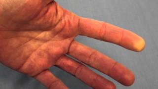 Raynauds Phenomenon Reduced Blood Flow of the FIngertip [upl. by Breskin]