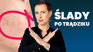 Blizny i przebarwienia po trądziku  jak się ich pozbyć [upl. by Lola117]