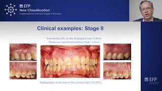 Assessing periodontitis clinical examples amp key points  tutorial by Mariano Sanz [upl. by Notsob]