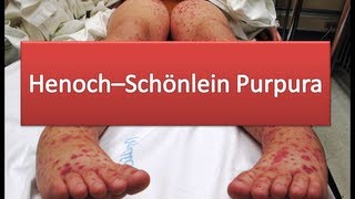 HenochSchönlein Purpura [upl. by Intihw]