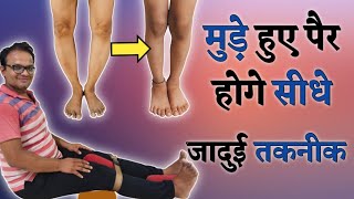 Best technique to correct bow legs knee pain relief knee arthritis treatment at home  fast result [upl. by Eltsirc]