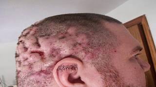 Stroke Cysts Boils Lesions Acne Mystery Diagnosis [upl. by Kristopher]