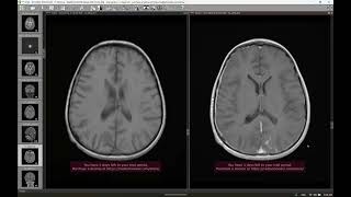 CNS tuberculoma [upl. by Ariaic]