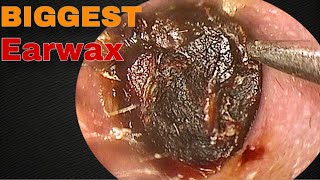 BIGGEST Earwax Difficult Removal EP 10  Doctor Anh [upl. by Lotson]