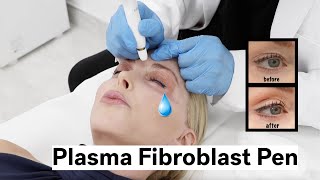 Plasma Fibroblast Pen to Treat Crepey Eyelids and Crows Feet Over 50 [upl. by Airetas374]