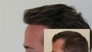 Hair Transplant Turkey Dense Packing Hairline Hairline Clinic [upl. by Waterer]