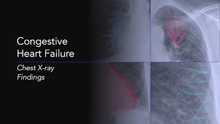 Congestive Heart Failure Explanation of Chest Xray Findings [upl. by Assereht31]