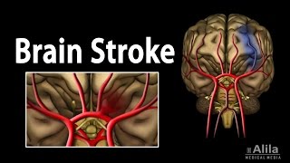 Brain Stroke Types of Causes Pathology Symptoms Treatment and Prevention Animation [upl. by Ormsby463]