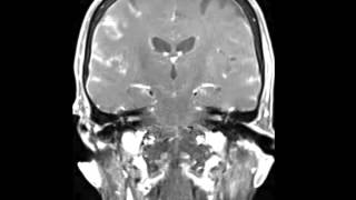 Leptomeningeal Carcinomatosis [upl. by Amalia454]