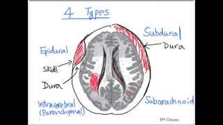 Intracranial Bleed  Part 1 [upl. by Lila]