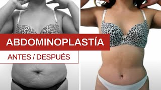 Abdominoplastía antes y después  Clínica Barrenechea [upl. by Tiphane]