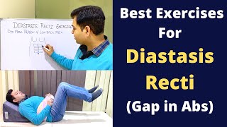 Exercises For Diastasis Recti Abdominal Seperation Diastasis Recti Treatment Reason of Back Pain [upl. by Nomed]