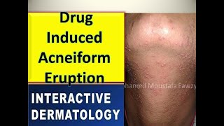 Drug induced acneiform eruption [upl. by Vacuva]