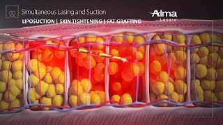 Liposuction Skin Tightening amp Fat Grafting  Lipo Life by Alma Lasers Medical Device 3D Animation [upl. by Haag]