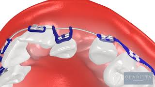 Oque é Ortodontia Como funciona um Aparelho Ortodôntico ortodontia invisalign clinicajin [upl. by Franzoni]