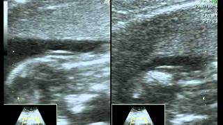 UltraSonografia 13 semanas  Morfológica TN  Alê e Airton [upl. by Eiggem]