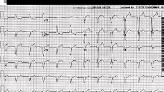 EKG Interpretation Beyond the Basics [upl. by Letty]