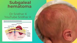 Subgaleal hematoma in babies Serious conditionnot to miss Dr Sridhar Kalyanasundaram [upl. by Freddy]