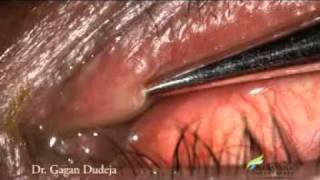 Mini Monoka Stent for Punctal Stenosis [upl. by Reehsab779]