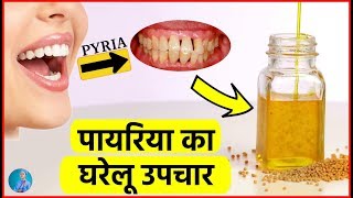 पायरिया का घरेलू इलाज │ Cure for PyriaPyorrhea Gums [upl. by Yasmeen]