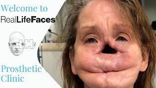 Welcome to Real Life Faces Prosthetic Clinic [upl. by Ettenor]