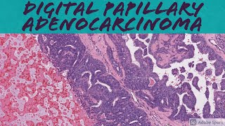 Aggressive Digital Papillary Adenocarcinoma 101 [upl. by Stegman]