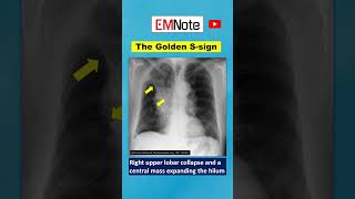 Golden S Sign medical doctor [upl. by Yvaht]