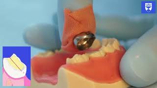 Stainless Steel Crown Technique for a Primary Molar Tooth [upl. by Dympha]