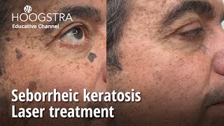 Seborrheic keratosis  Laser treatment  22341 [upl. by Sirraf384]