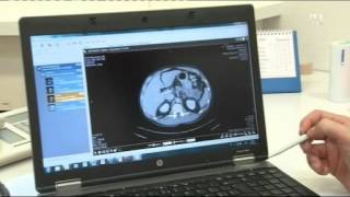 Pankreaskarzinom  Hirslanden amp Tele M1 Sendung „Gesundheitquot [upl. by Chapel]