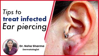 How to treat infected Ear Piercing  Timesxp [upl. by Atinyl354]