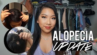 ALOPECIA  1 YEAR UPDATE  TIPS amp ADVICE  BeautyByBrinax3 [upl. by Houston]