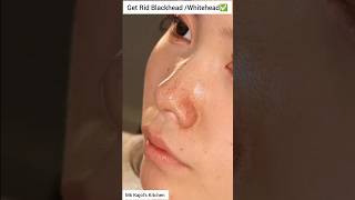 🔥Remove Blackheads amp Whiteheads Naturally  Get Rid Of Blackheads shorts blackheads ytshorts diy [upl. by Ititrefen945]