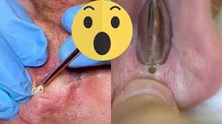 Blackhead Extractions A Satisfying Ear Cleaning Experience [upl. by Lebasiram]