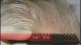 Hair Transplant Results  Norwood 5  3000 Grafts  Forhair Videos [upl. by Aicil]